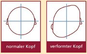 Abbildung by SimoNatal - Beispiel einer Kopfasymmetrie